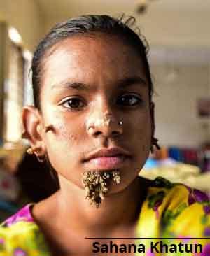 Bangladesh first female to suffer from tree man syndrome admitted to Dhaka hospital