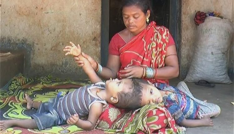 Odisha govt to provide medical assistance to conjoined twins