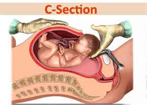 Curbing the surge in caesarean delivery : WHO revises childbirth guidelines to