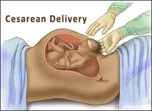 More Cesarean deliveries cases in India, says govt
