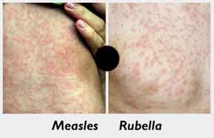 Kerala may extend Measles-Rubella vaccination date to achieve 100 percent target