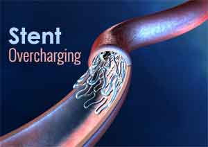 New Delhi: Metro Hospital fined Rs 1.26 Lakh for stent overcharging