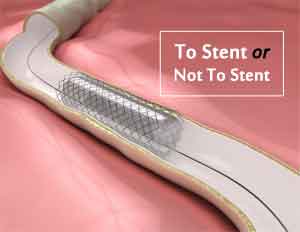 Audit of Stenting Procedures soon Mandatory: MCI