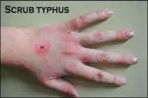 34 cases of scrub typhus infection reported in Mizoram