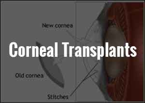 Over 1000 corneal transplants done at AIIMS in 2016: Titiyal
