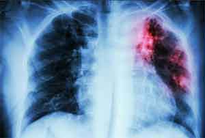 Himachal gears up to eliminate tuberculosis by 2023