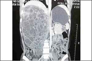 Sion Hospital doctors in Guinness book of World records for removing largest kidney tumour