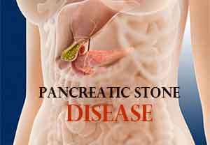 Pancreatic stone disease witnesses increase in Kashmir