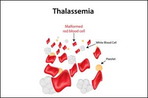 Frame guidelines on thalassemia treatment: SC to Centre