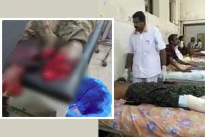 UP: Mans severed foot kept between his legs in Sultanpur hospital