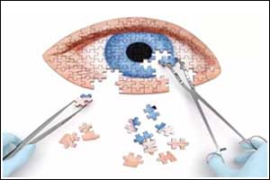 5 get infection after cataract surgery AIIMS Raipur