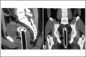 RML Doctors remove Shower head stuck in patients Rectum