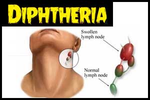 Diphtheria Deaths: Non-availability of Anti-Diphtheria Serum- ALARMING Situation