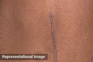 Sealing up Belly Button During Abdominoplasty: Aesthetic Surgeon told to pay Rs 2 lakh