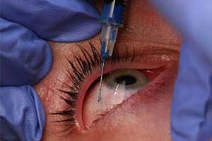 Faulty administration of Injection Avastin : Ophthalmologist told to pay Rs 1 lakh