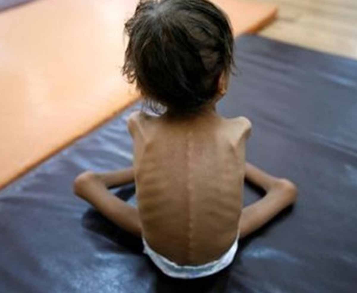 Ghaziabad: Malnourished children to get free treatment in 15 private hospitals